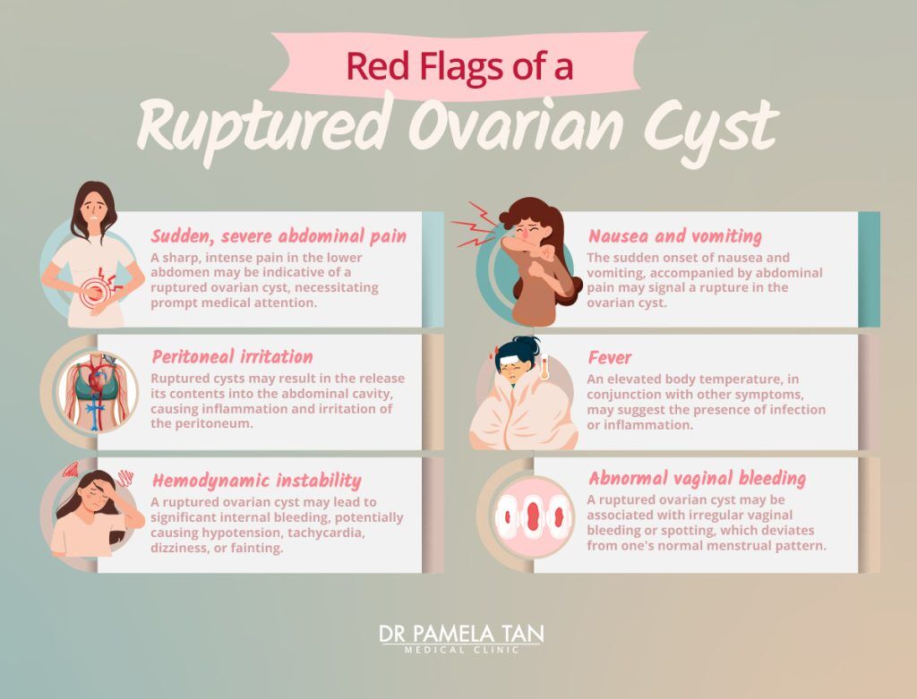 Everything You Need to Know About Ovarian Cysts   Dr Pamela Tan